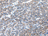 The image on the left is immunohistochemistry of paraffin-embedded Human liver cancer tissue using CSB-PA346332 (CFC1 Antibody) at dilution 1/30, on the right is treated with synthetic peptide. (Original magnification: ×200)