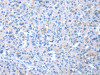 The image on the left is immunohistochemistry of paraffin-embedded Human liver cancer tissue using CSB-PA065893 (COLEC12 Antibody) at dilution 1/20, on the right is treated with synthetic peptide. (Original magnification: ×200)