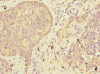 Immunohistochemistry of paraffin-embedded human gastric cancer using CSB-PA001094LA01HU at dilution of 1:100