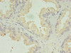 Immunohistochemistry of paraffin-embedded human prostate cancer using CSB-PA001117LA01HU at dilution of 1:100