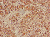 Immunohistochemistry of paraffin-embedded human liver cancer using CSB-PA001125LA01HU at dilution of 1:100