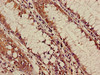 Immunohistochemistry of paraffin-embedded human colon cancer using CSB-PA001624LA01HU at dilution of 1:100