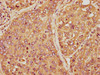 IHC image of CSB-PA001654YA01HU diluted at 1:150 and staining in paraffin-embedded human liver cancer performed on a Leica BondTM system. After dewaxing and hydration, antigen retrieval was mediated by high pressure in a citrate buffer (pH 6.0) . Section was blocked with 10% normal goat serum 30min at RT. Then primary antibody (1% BSA) was incubated at 4°C overnight. The primary is detected by a biotinylated secondary antibody and visualized using an HRP conjugated SP system.