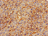 Immunohistochemistry of paraffin-embedded human liver cancer using CSB-PA001840HA01HU at dilution of 1:100