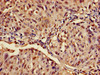 Immunohistochemistry of paraffin-embedded human lung cancer using CSB-PA002443LA01HU at dilution of 1:100