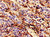 Immunohistochemistry analysis of human bladder cancer using CSB-PA002600EA01HU at dilution of 1:100