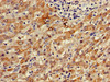 Immunohistochemistry of paraffin-embedded human liver cancer using CSB-PA002922LA01HU at dilution of 1:100