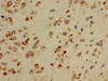 Immunohistochemistry of paraffin-embedded human glioma using CSB-PA00414A0Rb at dilution of 1:100