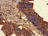 Immunohistochemistry of paraffin-embedded human colon cancer using CSB-PA00535A0Rb at dilution of 1:100