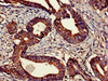 Immunohistochemistry of paraffin-embedded human colon cancer using CSB-PA005684EA01HU at dilution of 1:100