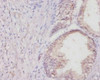 Immunohistochemistry of paraffin-embedded human colon cancer using CSB-PA005727YA01RA at dilution of 1:20