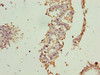 Immunohistochemistry of paraffin-embedded human breast cancer using CSB-PA005935DA01HU at dilution of 1:100