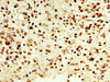 IHC image of CSB-PA006494LA01HU diluted at 1:500 and staining in paraffin-embedded human glioma performed on a Leica BondTM system. After dewaxing and hydration, antigen retrieval was mediated by high pressure in a citrate buffer (pH 6.0) . Section was blocked with 10% normal goat serum 30min at RT. Then primary antibody (1% BSA) was incubated at 4°C overnight. The primary is detected by a biotinylated secondary antibody and visualized using an HRP conjugated SP system.