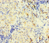 Immunohistochemistry of paraffin-embedded human lung cancer using CSB-PA007930HA01HU at dilution of 1:100
