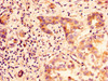 IHC image of CSB-PA009503LA01HU diluted at 1:100 and staining in paraffin-embedded human liver cancer performed on a Leica BondTM system. After dewaxing and hydration, antigen retrieval was mediated by high pressure in a citrate buffer (pH 6.0) . Section was blocked with 10% normal goat serum 30min at RT. Then primary antibody (1% BSA) was incubated at 4°C overnight. The primary is detected by a biotinylated secondary antibody and visualized using an HRP conjugated SP system.