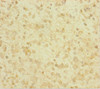 Immunohistochemistry of paraffin-embedded human glioma using CSB-PA009521EA01HU at dilution of 1:100