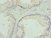 Immunohistochemistry of paraffin-embedded human prostate cancer using CSB-PA009586LA01HU at dilution of 1:100
