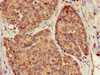 Immunohistochemistry of paraffin-embedded human ovarian cancer using CSB-PA009608LA01HU at dilution of 1:100