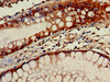 Immunohistochemistry of paraffin-embedded human colon cancer using CSB-PA009610LA01HU at dilution of 1:100