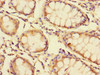 Immunohistochemistry of paraffin-embedded human colon cancer using CSB-PA009669LA01HU at dilution of 1:100