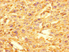 Immunohistochemistry of paraffin-embedded human melanoma using CSB-PA009669LA01HU at dilution of 1:100