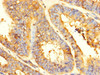 Immunohistochemistry of paraffin-embedded human endometrial cancer using CSB-PA009711LA01HU at dilution of 1:100