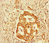 Immunohistochemistry of paraffin-embedded human pancreatic cancer using CSB-PA009792LA01HU at dilution of 1:100