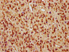 IHC image of CSB-PA00985A0Rb diluted at 1:260 and staining in paraffin-embedded human glioma performed on a Leica BondTM system. After dewaxing and hydration, antigen retrieval was mediated by high pressure in a citrate buffer (pH 6.0) . Section was blocked with 10% normal goat serum 30min at RT. Then primary antibody (1% BSA) was incubated at 4°C overnight. The primary is detected by a biotinylated secondary antibody and visualized using an HRP conjugated SP system.