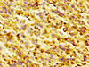 IHC image of CSB-PA009965HA01HU diluted at 1:300 and staining in paraffin-embedded human glioma performed on a Leica BondTM system. After dewaxing and hydration, antigen retrieval was mediated by high pressure in a citrate buffer (pH 6.0) . Section was blocked with 10% normal goat serum 30min at RT. Then primary antibody (1% BSA) was incubated at 4°C overnight. The primary is detected by a biotinylated secondary antibody and visualized using an HRP conjugated SP system.