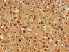 Immunohistochemistry of paraffin-embedded human liver cancer using CSB-PA009970LA01HU at dilution of 1:100