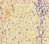 Immunohistochemistry of paraffin-embedded human liver cancer using CSB-PA010109LA01HU at dilution of 1:100