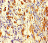 Immunohistochemistry of paraffin-embedded human melanoma using CSB-PA010109LA01HU at dilution of 1:100