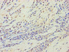 Immunohistochemistry of paraffin-embedded human breast cancer using CSB-PA010138HA01HU at dilution of 1:100