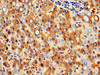 IHC image of CSB-PA010150LA01HU diluted at 1:300 and staining in paraffin-embedded human liver cancer performed on a Leica BondTM system. After dewaxing and hydration, antigen retrieval was mediated by high pressure in a citrate buffer (pH 6.0) . Section was blocked with 10% normal goat serum 30min at RT. Then primary antibody (1% BSA) was incubated at 4°C overnight. The primary is detected by a biotinylated secondary antibody and visualized using an HRP conjugated SP system.