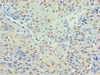 Immunohistochemistry of paraffin-embedded human breast cancer using CSB-PA010239LA01HU at dilution of 1:100