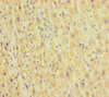 Immunohistochemistry of paraffin-embedded human liver cancer using CSB-PA010288LA01HU at dilution of 1:100