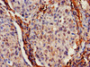 IHC image of CSB-PA011025LA01HU diluted at 1:700 and staining in paraffin-embedded human lung cancer performed on a Leica BondTM system. After dewaxing and hydration, antigen retrieval was mediated by high pressure in a citrate buffer (pH 6.0) . Section was blocked with 10% normal goat serum 30min at RT. Then primary antibody (1% BSA) was incubated at 4°C overnight. The primary is detected by a biotinylated secondary antibody and visualized using an HRP conjugated SP system.