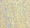 Immunohistochemistry of paraffin-embedded human liver cancer using CSB-PA011156LA01HU at dilution of 1:100