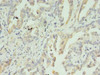 Immunohistochemistry of paraffin-embedded human lung cancer using CSB-PA011701LA01HU at dilution of 1:100