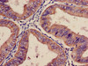 Immunohistochemistry of paraffin-embedded human endometrial cancer using CSB-PA011864LA01HU at dilution of 1:100