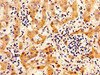 IHC image of CSB-PA011897LA01HU diluted at 1:300 and staining in paraffin-embedded human liver cancer performed on a Leica BondTM system. After dewaxing and hydration, antigen retrieval was mediated by high pressure in a citrate buffer (pH 6.0) . Section was blocked with 10% normal goat serum 30min at RT. Then primary antibody (1% BSA) was incubated at 4°C overnight. The primary is detected by a biotinylated secondary antibody and visualized using an HRP conjugated SP system.