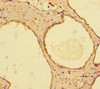Immunohistochemistry of paraffin-embedded human prostate cancer using CSB-PA01195A0Rb at dilution of 1:100