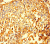 Immunohistochemistry of paraffin-embedded human lung cancer using CSB-PA01195A0Rb at dilution of 1:100
