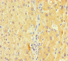 Immunohistochemistry of paraffin-embedded human liver cancer using CSB-PA012011LA01HU at dilution of 1:100