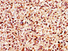 IHC image of CSB-PA012048LA01HU diluted at 1:400 and staining in paraffin-embedded human glioma performed on a Leica BondTM system. After dewaxing and hydration, antigen retrieval was mediated by high pressure in a citrate buffer (pH 6.0) . Section was blocked with 10% normal goat serum 30min at RT. Then primary antibody (1% BSA) was incubated at 4°C overnight. The primary is detected by a biotinylated secondary antibody and visualized using an HRP conjugated SP system.