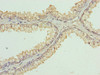 Immunohistochemistry of paraffin-embedded human prostate cancer using CSB-PA012141LA01HU at dilution of 1:100