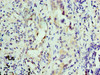 Immunohistochemistry of paraffin-embedded human lung cancer using CSB-PA012483LA01HU at dilution of 1:100