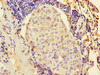 Immunohistochemistry of paraffin-embedded human lung cancer using CSB-PA012561EA01HU at dilution of 1:100