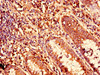 Immunohistochemistry of paraffin-embedded human colon cancer using CSB-PA012576LA01HU at dilution of 1:100