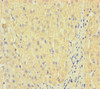 Immunohistochemistry of paraffin-embedded human liver cancer using CSB-PA012722LA01HU at dilution of 1:100